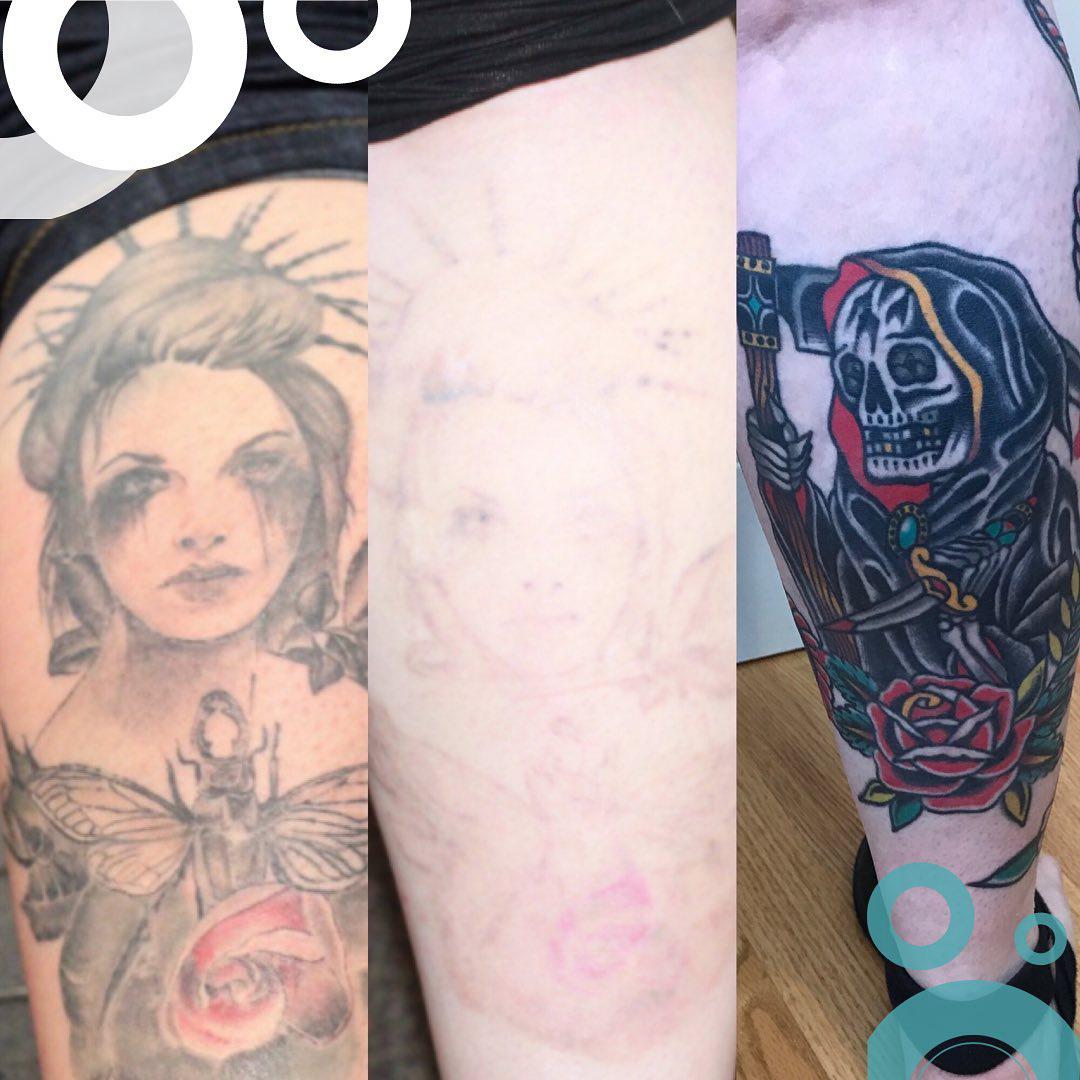Removery Tattoo Removal & Fading 3839 Emery St Ste 500, Emeryville California 94608